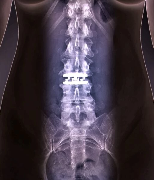 Artificial spinal disc, X-ray C016  /  6562