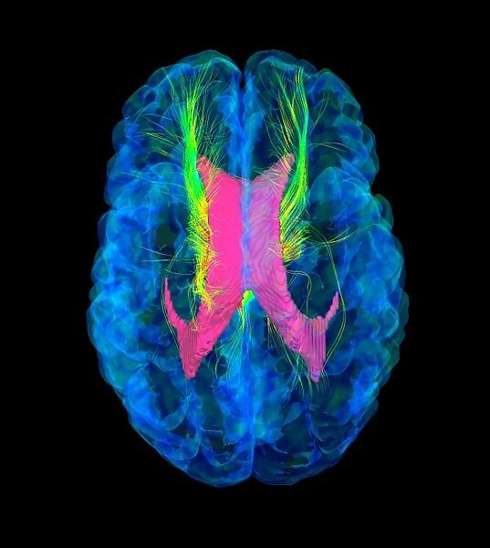 Brain fibres, DTI MRI scan C017  /  7037