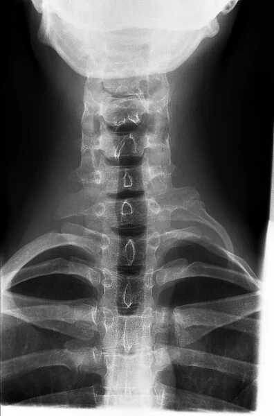 Cervical rib, X-ray C017  /  8024