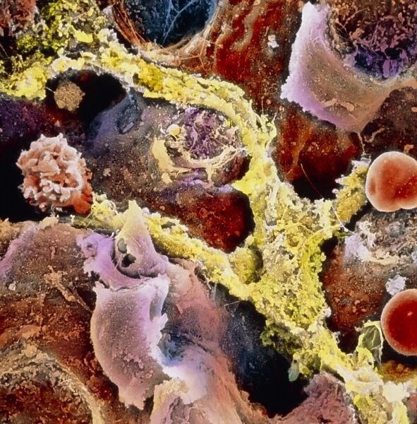 Coloured SEM of liver tissue with fibrosis