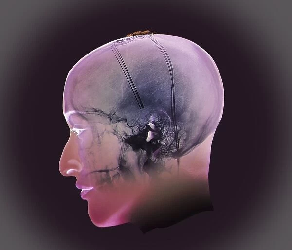 Deep brain stimulation, X-ray