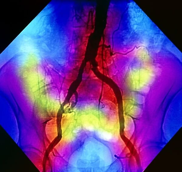 False-colour normal abdominal angiogram