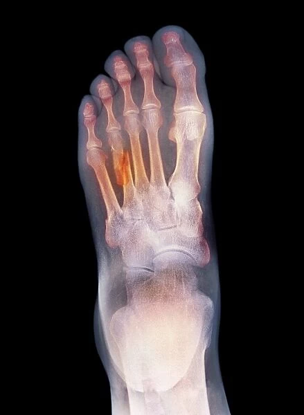 Fractured foot, X-ray