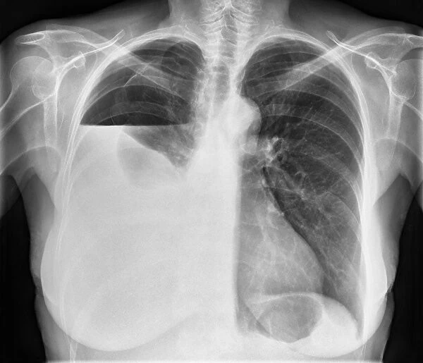 Hydropneumothorax, X-ray C017  /  7810