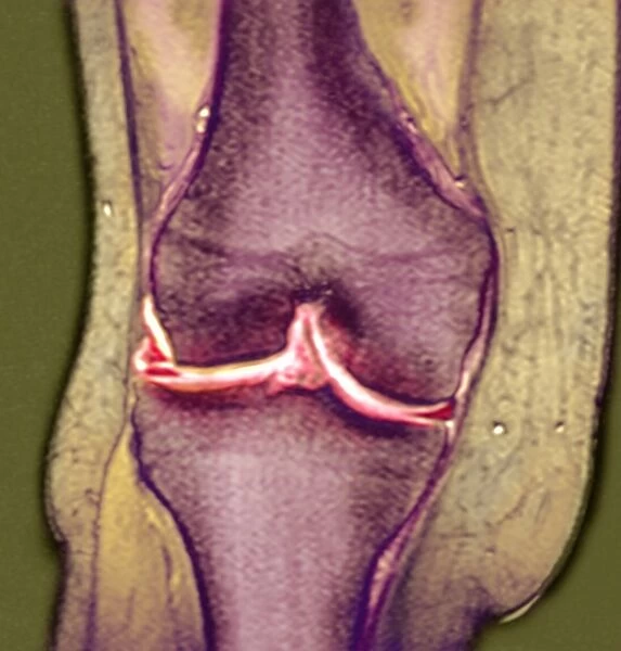 Knee meniscus tear
