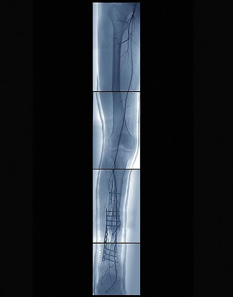 Pinned broken leg, angiogram C018  /  0391