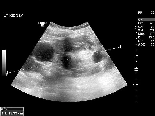Polycystic kidney, ultrasound scan C017  /  7746