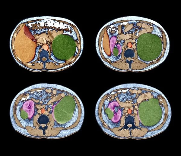 Polycystic kidneys, CT scans C018  /  0571