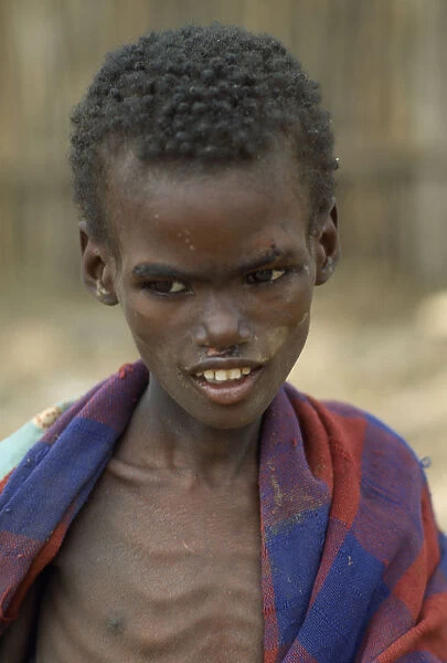 20074879. SOMALIA Baidoa Severely malnourished child at CONCERN feeding centre. Center