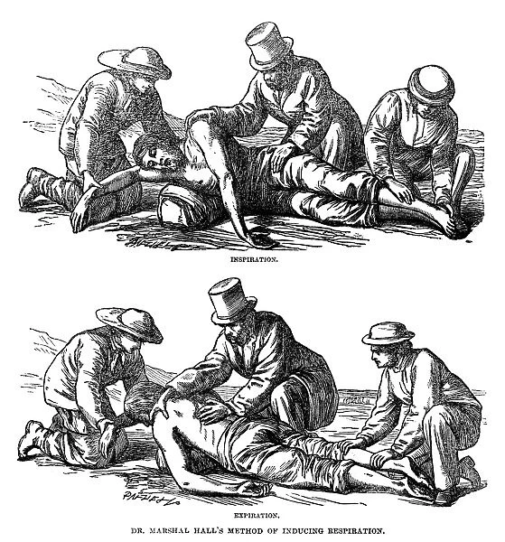 ARTIFICIAL RESPIRATION, 1864. Dr. Marshall Halls method for artificial respiration