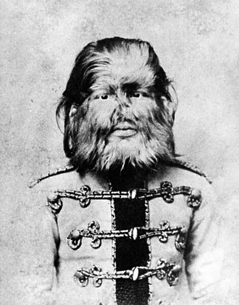 DOG-FACED BOY. Feodor Jeftichew (1868-1904), known as Jo-Jo the Dog-faced Boy
