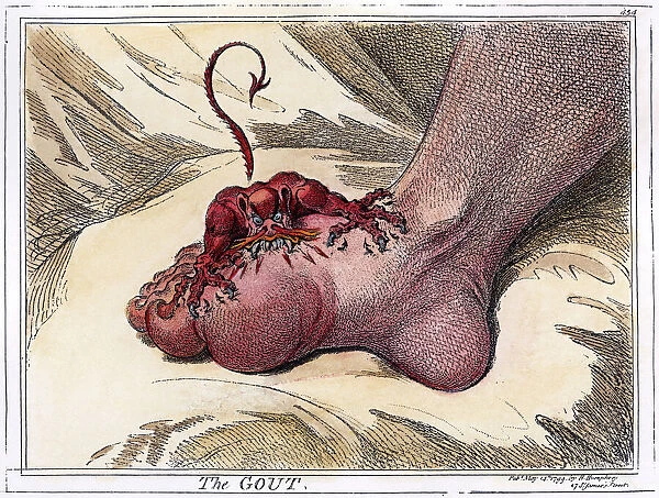 The Gout. Etching, 1799, by James Gillray