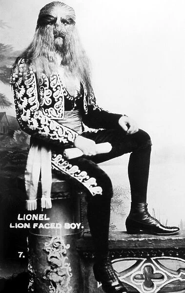 LION-FACED MAN, 1907. Stephan Bibrowsky (1890-1932), known as Lionel the Lion-Faced Man. Sideshow performer with Barnum & Baileys circus. Photograph, 1907