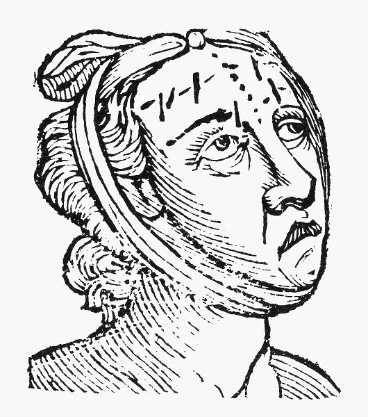 PHYSIOGNOMY, 1648. Forehead of a vicious woman. Woodcut from Philippus Phinellas Metoposcopia