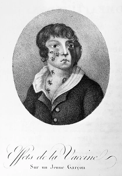 SMALLPOX VACCINATION, 1807. A young victim of a poorly administered smallpox vaccine. Stipple engraving, French, 1807