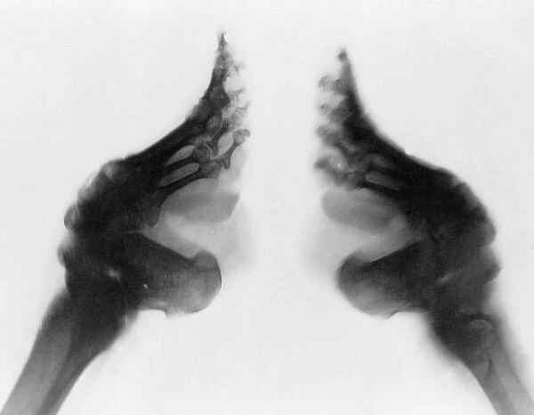 An x-ray of a lily footed woman of China, c1890-1923