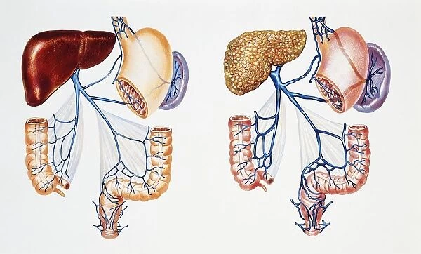 Portal vein system, Normal portal circulation compared with portal circulation in presence of hepatic cirrhosis, drawing