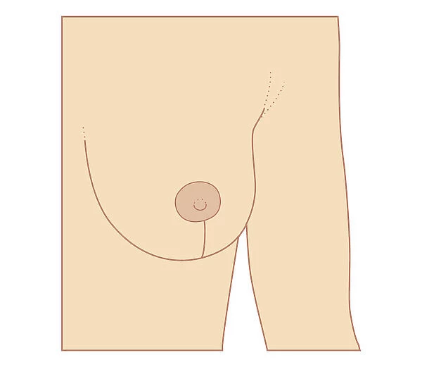Cross section biomedical illustration of incision site for breast reduction procedure