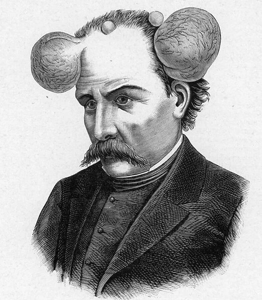Representation of a person with magnifying glass, scalp cysts (engraving)