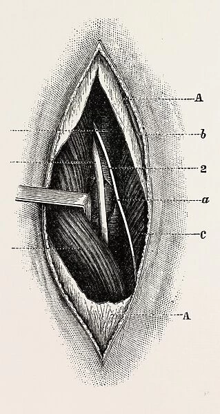 ligature of, femoral are the long saphenous nerve, medical equipment, surgical instrument
