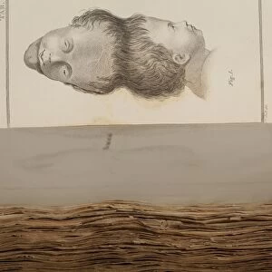 1787 Two Headed boy of Bengal by E. Home