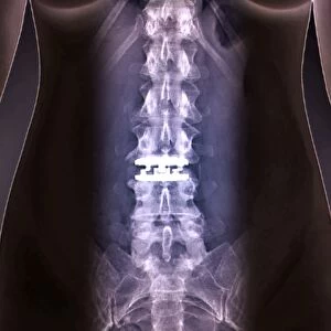 Artificial spinal disc, X-ray C016 / 6562