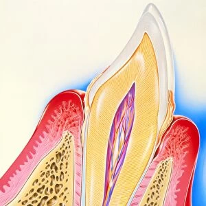 Artwork of tooth showing periodontal disease