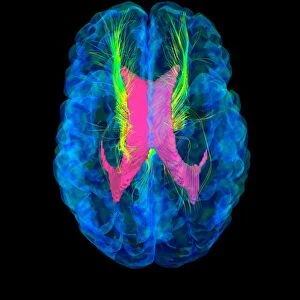 Brain fibres, DTI MRI scan C017 / 7037