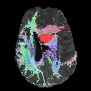Brain tumour, DTI MRI scan C017 / 7059