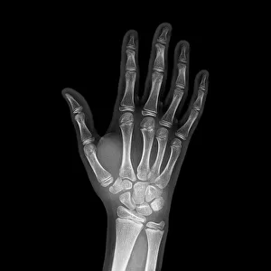 Broken wrist bone, X-ray C017 / 7187