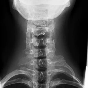 Cervical rib, X-ray C017 / 8024