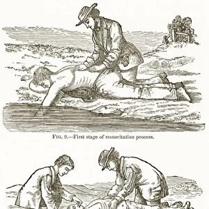 Emergency resuscitation, 19th century C015 / 6082