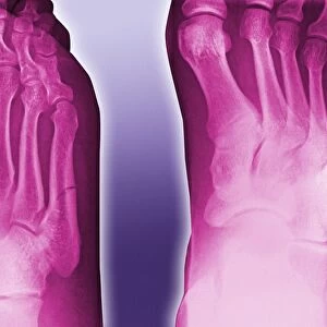 Fractured foot, coloured X-ray