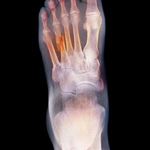 Fractured foot, X-ray