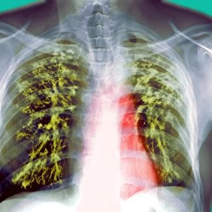 Lung scarring from tuberculosis, X-ray