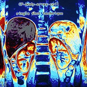 MRI scan of human abdomen showing kidneys & liver