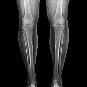 Normal legs, X-rays