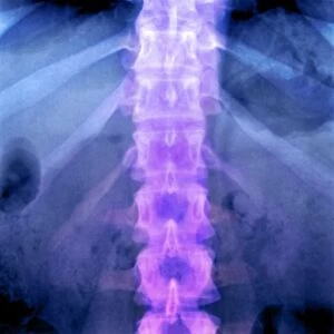 Normal lumbar spine, X-ray