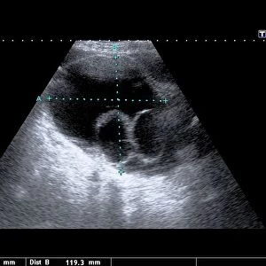 Ovarian cysts, ultrasound scan C017 / 8018
