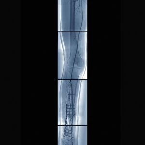 Pinned broken leg, angiogram C018 / 0391