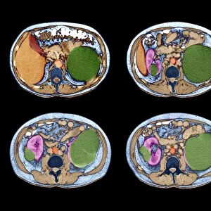 Polycystic kidneys, CT scans C018 / 0571