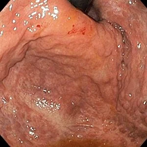 Severe gastritis, endoscope view C016 / 3898