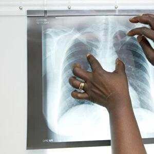 Tuberculosis X-ray diagnosis