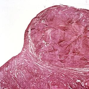 Uterine fibroid, light micrograph C015 / 6412
