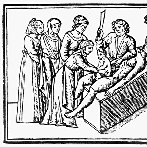 The apocryphal birth of Julius Caesar in 100 B. C. by caesarian operation. Woodcut from an early 16th century manuscript of Suetonius Lives of the Caesars
