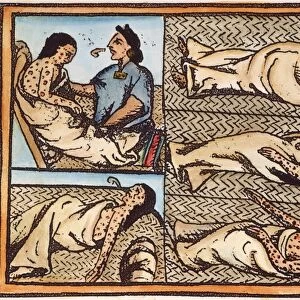 Aztec natives, with smallpox contracted from the Spaniards, ministered to by a medicine man. Illustration from Father Bernardino de Sahaguns 16th century treatise, General History of the Things of New Spain