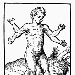 BOY MONSTER, 1573. Boy monster with four arms and four legs