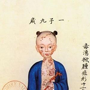 Chinese girl suffering from smallpox: watercolor