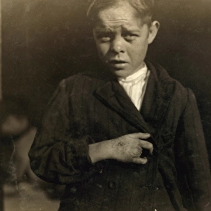 HINE: CHILD LABOR, 1912. A young cotton mill worker injured by a piece of machinery