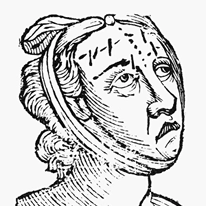 PHYSIOGNOMY, 1648. Forehead of a vicious woman. Woodcut from Philippus Phinellas Metoposcopia